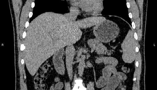 Adrenal myelolipoma (Radiopaedia 84321-99619 Coronal non-contrast 41).jpg