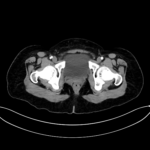 Adrenocortical carcinoma (Radiopaedia 87281-103569 Axial C+ arterial phase 86).jpg