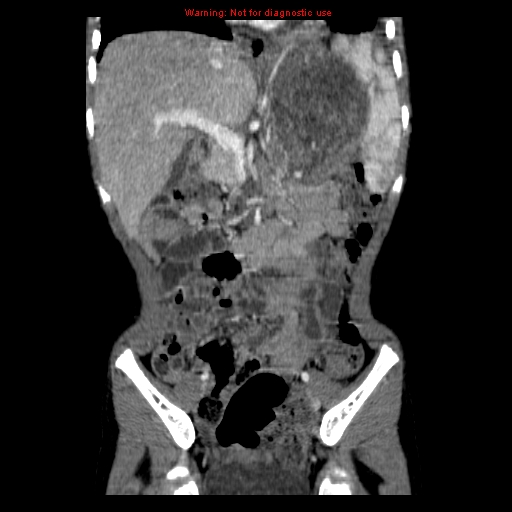 File:Adrenocortical carcinoma (Radiopaedia 9449-10131 Coronal C+ portal venous phase 5).jpg