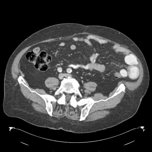Adult ileal intussusception with secondary obstruction (Radiopaedia 30395-31051 Axial C+ portal venous phase 52).jpg