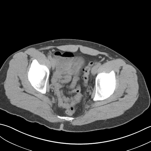 File:Adult polycystic kidney disease (Radiopaedia 47866-52626 Axial non-contrast 76).png
