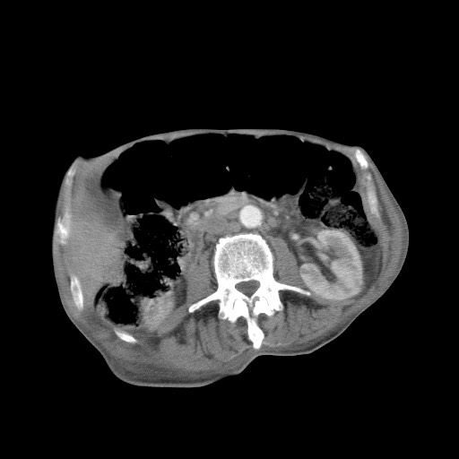 Aggressive lung cancer with cardiac metastases, pulmonary artery tumor thrombus, and Budd-Chiari (Radiopaedia 60320-67981 A 69).jpg