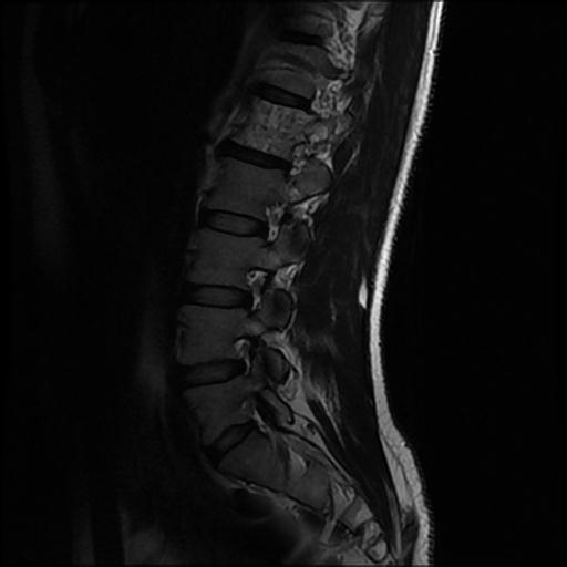 File:Aggressive vertebral hemangioma with pathological fracture (Radiopaedia 69528-79411 Sagittal T2 2).jpg