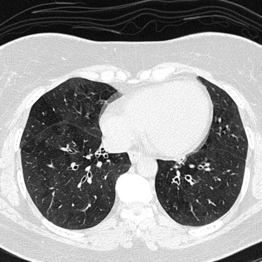 Air trapping in small airway disease (Radiopaedia 61685-69694 Axial lung window 118).jpg