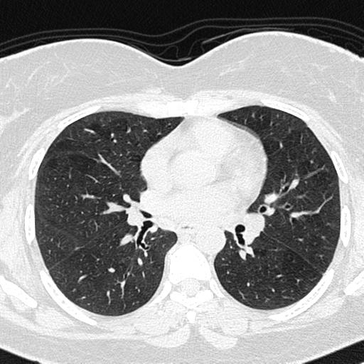 Air trapping in small airway disease (Radiopaedia 61685-69694 Axial lung window 82).jpg