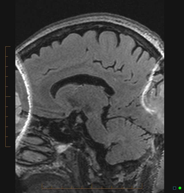 Aliasing artifact causing a spurious cerebellar lesion (Radiopaedia 48783-53810 Sagittal FLAIR 26).jpg