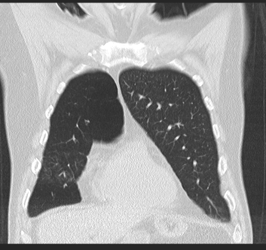 Allergic bronchopulmonary aspergillosis (Radiopaedia 44760-48571 Coronal lung window 17).png