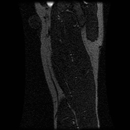 Alveolar soft part sarcoma (Radiopaedia 64501-73678 D 40).jpg