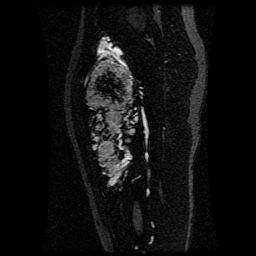Alveolar soft part sarcoma (Radiopaedia 64501-73678 D 72).jpg