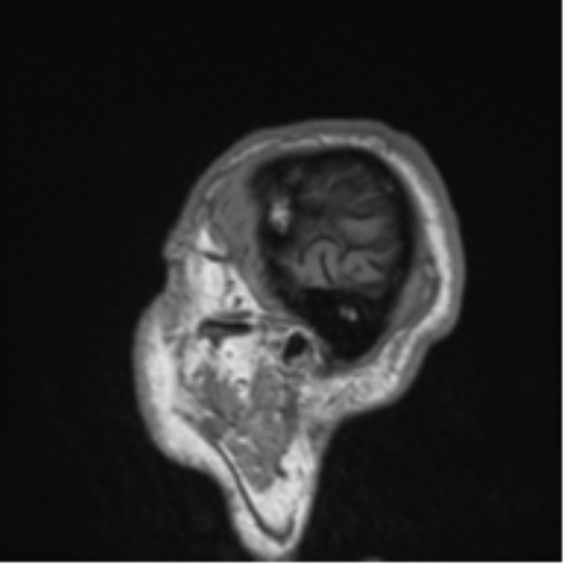 File:Alzheimer's disease- with Gerstmann syndrome and dressing apraxia (Radiopaedia 54882-61150 Sagittal T1 3).png