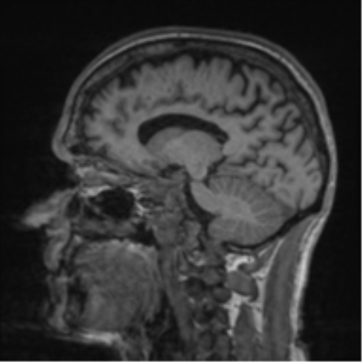 File:Alzheimer's disease- with apraxia (Radiopaedia 54763-61011 Sagittal T1 29).png