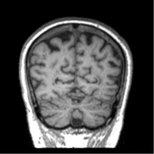 File:Alzheimer disease and cerebral amyloid angiopathy (Radiopaedia 64234-73011 Coronal T1 7).png
