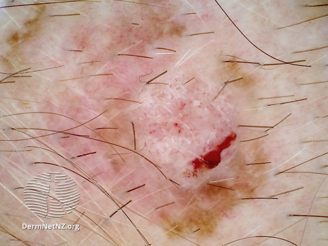 File:Amelanotic melanoma dermoscopy (DermNet NZ amelanotic-melanoma-scalp).jpg