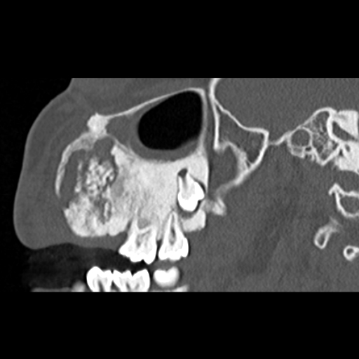 File:Ameloblastic fibro-odontoma (Radiopaedia 18843-18780 bone window 9).jpg