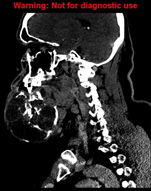 Ameloblastoma (Radiopaedia 33126-34164 F 30).jpg