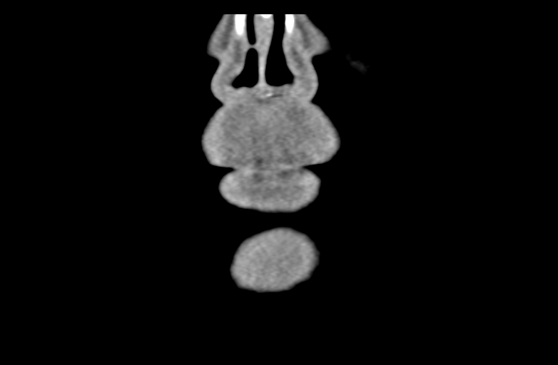 Ameloblastoma (Radiopaedia 33677-34806 Coronal non-contrast 10).png
