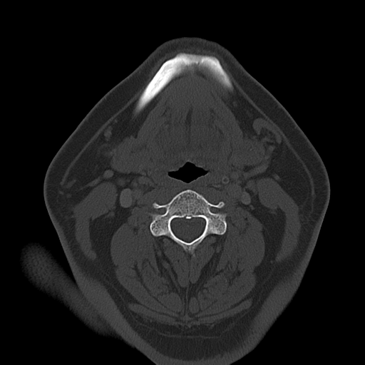 Ameloblastoma (Radiopaedia 38520-40623 Axial bone window 38).png