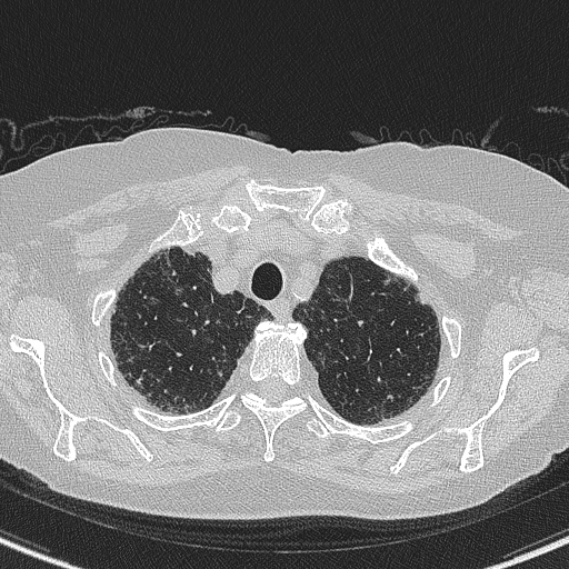 Amiodarone-induced pulmonary fibrosis (Radiopaedia 82355-96460 Axial lung window 12).jpg