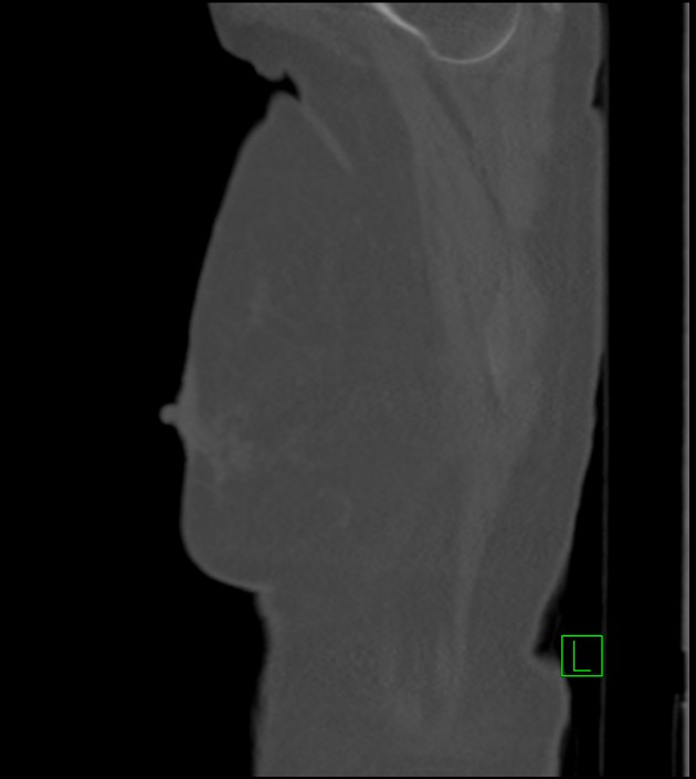 Amiodarone deposition in the liver (Radiopaedia 77587-89780 Sagittal bone window 93).jpg