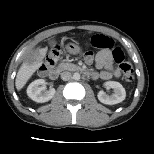 Amoebic liver abscesses (Radiopaedia 55536-62009 A 40).jpg