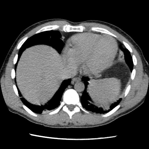 Amoebic liver abscesses (Radiopaedia 55536-62009 Axial C+ delayed 10).jpg