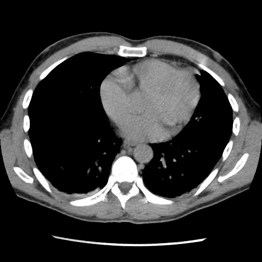 Amoebic liver abscesses (Radiopaedia 55536-62009 Axial C+ delayed 5).jpg