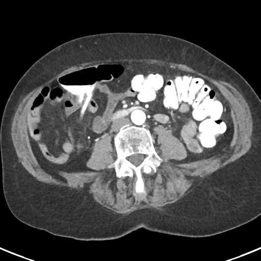 Ampullary adenocarcinoma (Radiopaedia 34013-35237 B 57).png