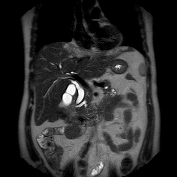File:Ampullary tumor (Radiopaedia 27294-27479 Coronal T2 11).jpg
