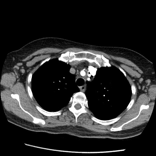 File:Amyloidosis - bronchial and diffuse nodular pulmonary involvement (Radiopaedia 60156-67745 A 12).jpg