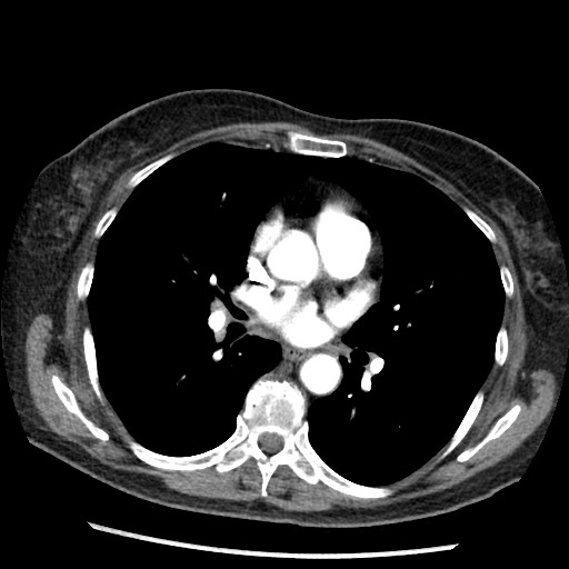Amyloidosis - bronchial and diffuse nodular pulmonary involvement (Radiopaedia 60156-67745 A 27).jpg