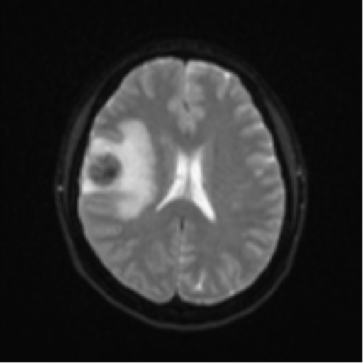 Anaplastic astroblastoma (Radiopaedia 55666-62194 Axial DWI 18).png