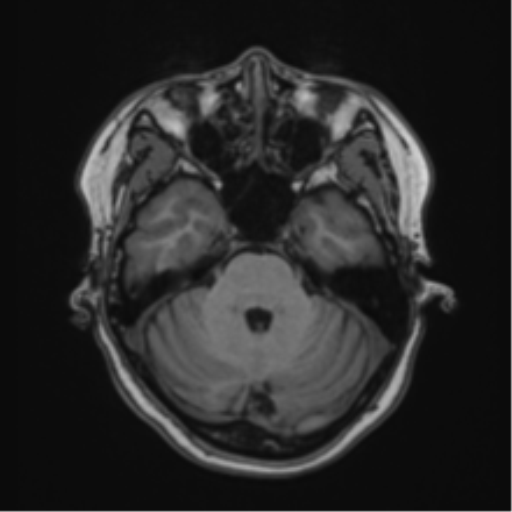 Anaplastic astroblastoma (Radiopaedia 55666-62194 Axial T1 21).png