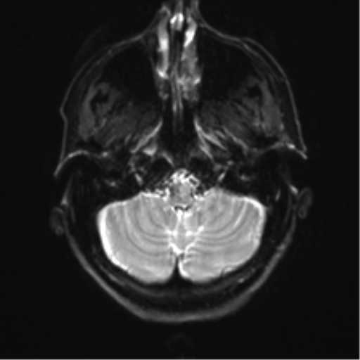File:Anaplastic astrocytoma - thalamic glioma (Radiopaedia 59709-67115 Axial DWI 5).png