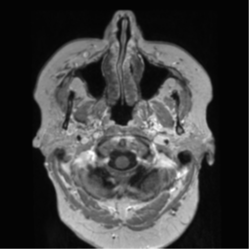 Anaplastic astrocytoma IDH wild-type (pseudoprogression) (Radiopaedia 42209-45278 Axial T1 C+ 21).png