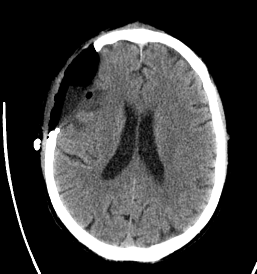 File:Anaplastic meningioma with recurrence (Radiopaedia 34452-35786 Axial non-contrast 20).png
