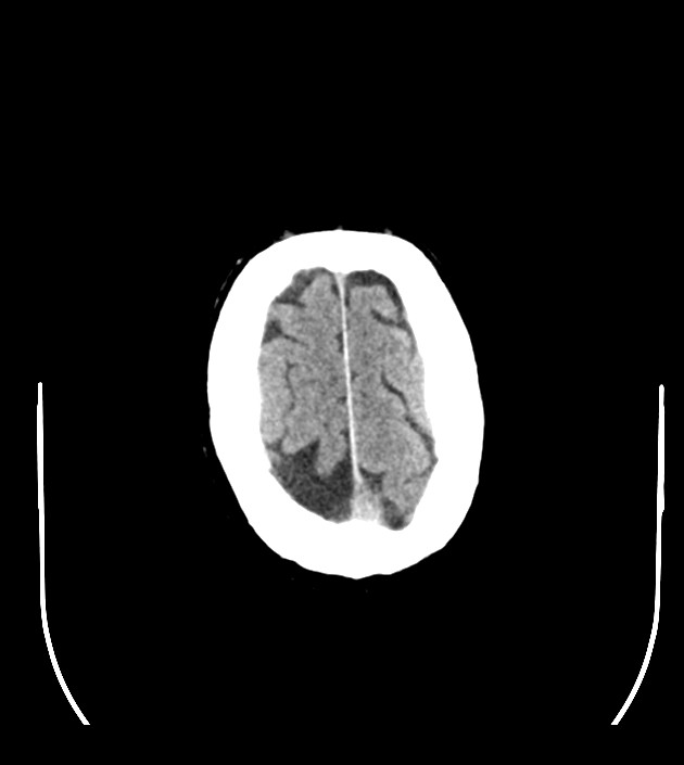 Anaplastic oligodendroglioma (Radiopaedia 79571-92755 Axial non-contrast 48).jpg
