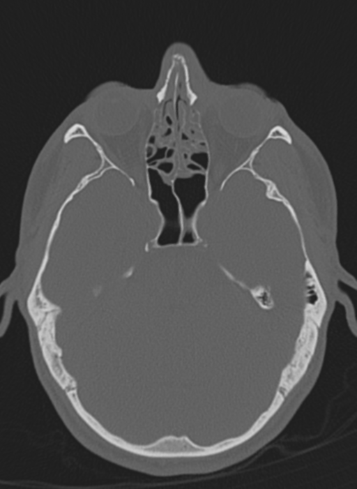 Anaplastic oligodendroglioma with skull fracture (Radiopaedia 74831-85846 Axial bone window 52).png