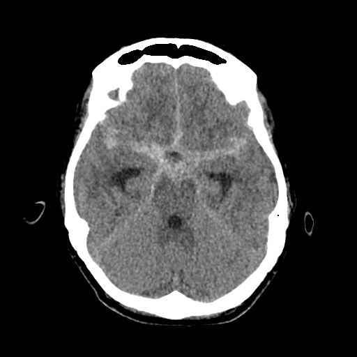 Aneursym related subarachnoid hemorrhage with hydrocephalus (Radiopaedia 45105-49083 Axial non-contrast 15).jpg