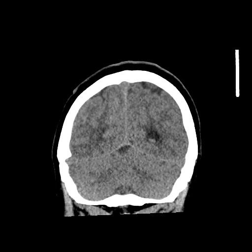 Aneursym related subarachnoid hemorrhage with hydrocephalus (Radiopaedia 45105-49083 Coronal non-contrast 54).jpg