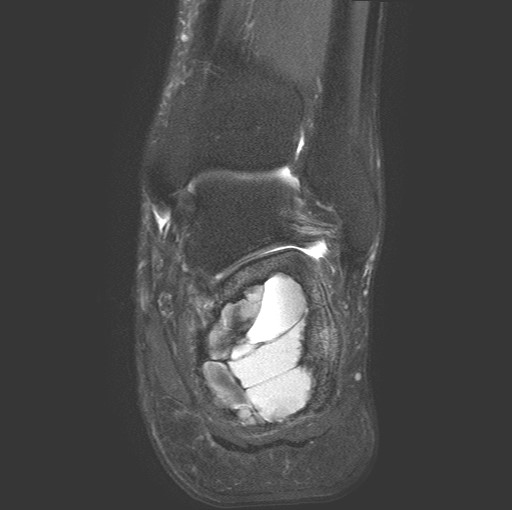 File:Aneurysmal bone cyst of the calcaneus (Radiopaedia 60669-68420 Coronal T2 fat sat 14).jpg
