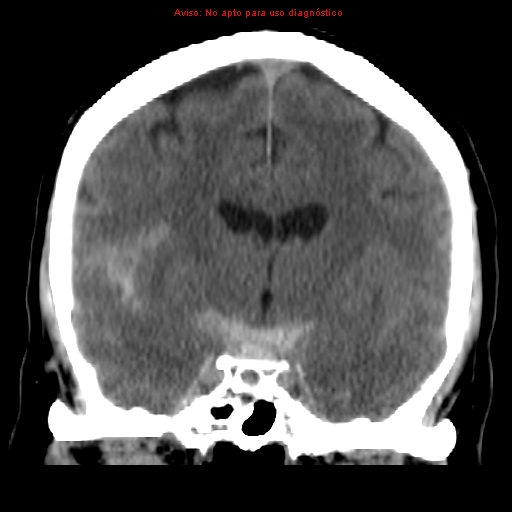 File:Aneurysmal subarachnoid hemorrhage (Radiopaedia 24740-24997 Coronal non-contrast 22).jpg