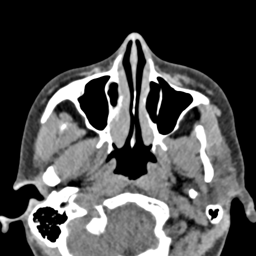 Angular dermoid cyst (Radiopaedia 88967-105790 Axial non-contrast 14).jpg