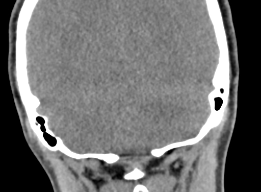 Angular dermoid cyst (Radiopaedia 88967-105790 Coronal non-contrast 100).jpg