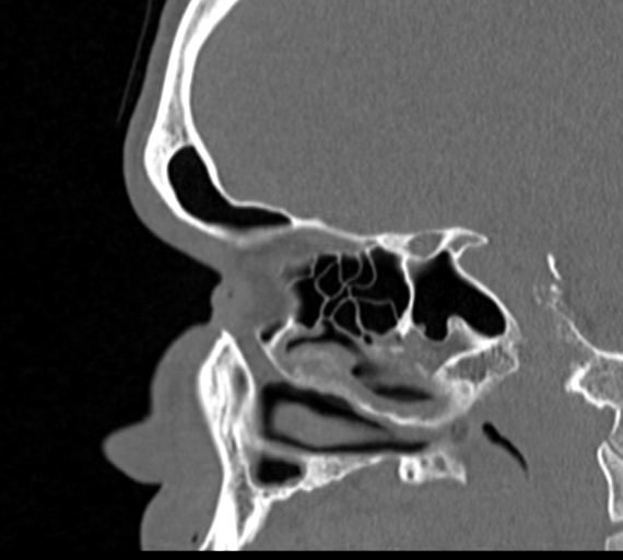 Angular epidermoid cyst (Radiopaedia 46908-51439 Sagittal bone window 30).png