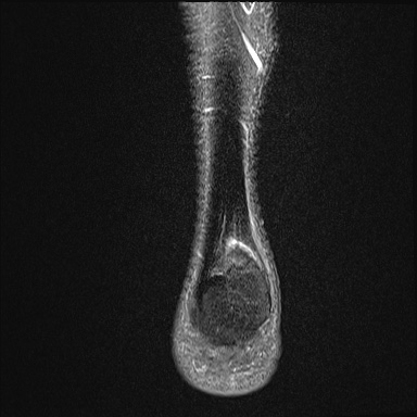 File:Ankle syndesmotic injury (Radiopaedia 69066-78837 Coronal PD fat sat 5).jpg