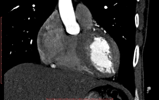 Anomalous left coronary artery from the pulmonary artery (ALCAPA) (Radiopaedia 70148-80181 B 105).jpg
