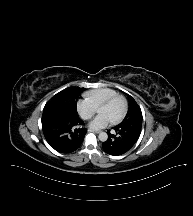 Anterior abdominal wall CSF pseudocyst (CSFoma) (Radiopaedia 79453-92571 A 5).jpg