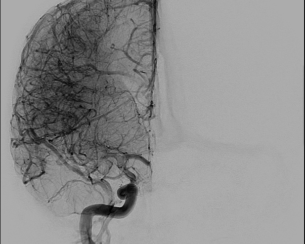 File:Anterior cerebral artery aneurysm (Radiopaedia 80683-94128 A 7).jpg