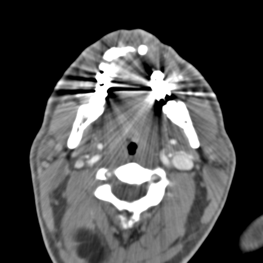 File:Anterior cerebral artery territory infarct (Radiopaedia 39327-41581 B 65).png