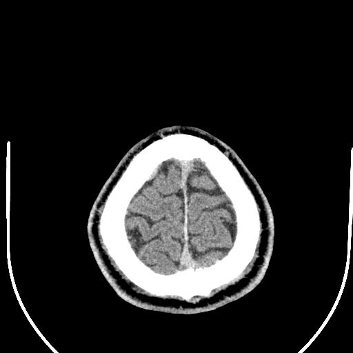 Anterior choroidal artery infarct (Radiopaedia 55106-61480 Axial non-contrast 59).jpg